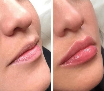 до після контурної пластики губ
