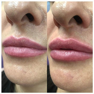 до після корекції губ