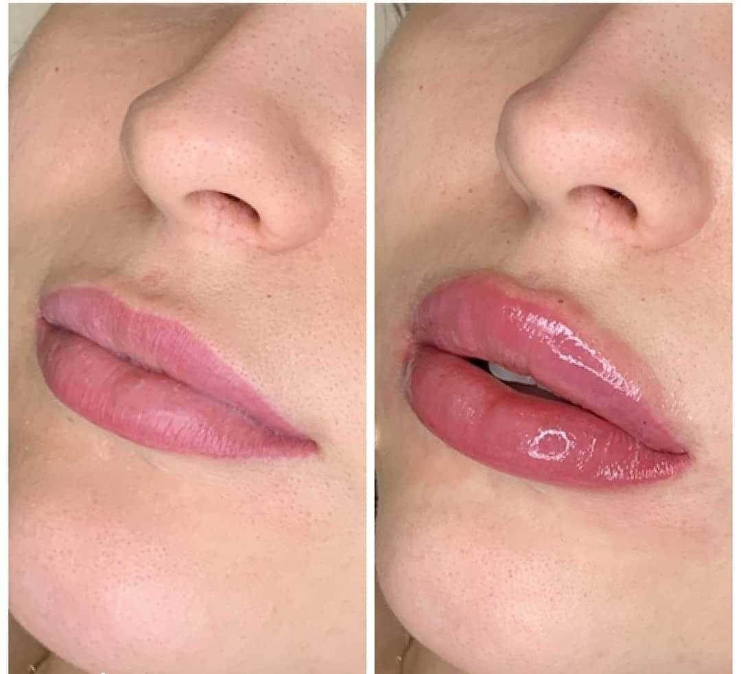 до після збільшення губ