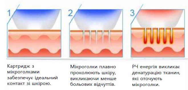 Поетапний принцип роботи мікроголкового РФ-ліфтингу