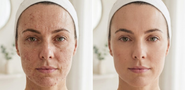 До/після dermapen.beforeafter.medestet