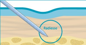 Введення Radiesse радіес1
