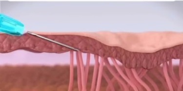 subcizijaprocess